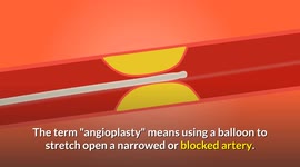 Coronary Angioplasty And Stenting :- Indications, Procedures, Risks & Complications