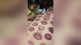 Chinese girl draws animal faces over marks on father's back left from cupping therapy