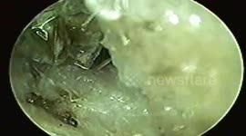 Doctor removes giant living cockroach lodged in woman's ear in Vietnam