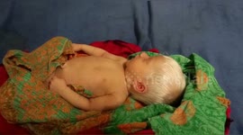 WOW ONE IN THOUSANDS! Snow White was born in Bhagalpur, Munger's woman became mother