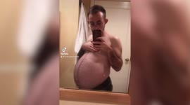 Transgender man's 'pregnant belly' turns out to be a huge ovarian tumor