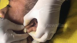Gruesome footage shows Vietnamese dermatologist removing 8-year-old pimple from man's ear