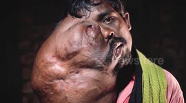 31-year-old battling face tumor gets successfully treated in southern India