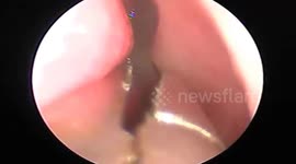 Vietnamese doctor removes a leech stuck in a woman's NOSE