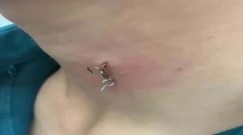 The doctor performed surgery to remove the hook from the man's neck when he went fishing
