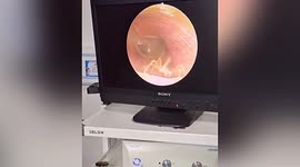 Doctor removes live spider from woman's ear in China