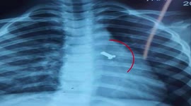 Vietnamese doctor removes metal screw from LUNG of three-year-old boy