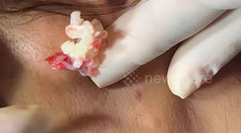 Look away now if you're squeamish! Vietnamese dermatologist pops giant 15-year-old spot