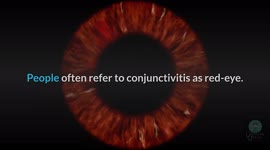 Conjunctivitis (Pink Eye) :- Causes, Symptoms & Treatment