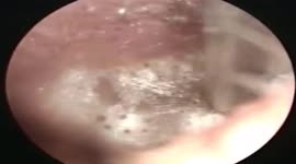 Eeew! Bizarre moment Vietnamese doctor removes 'mushroom' from patient's ear