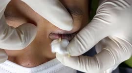 Vietnamese dermatologist carefully removes rare acne from woman's eyes