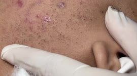 Blackheads Field Extraction On The Face