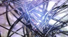 Hundreds of lice parasitize a woman's scalp and hair