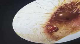 Vietnamese doctor removes beetle that was nesting in patient's ear