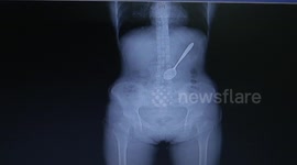 Woman swallows a 15cm spoon when eating noodles