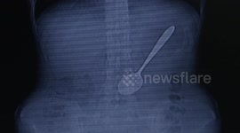 15CM spoon removed after woman swallows it in China