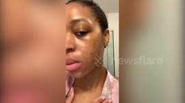 Canadian influencer cures her acne by dropping McDonalds and dairy