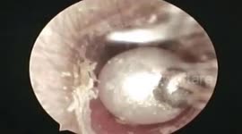 Vietnamese doctor removes pearl stuck in woman's ear canal