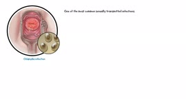 Chlamydia Infection - Causes, Risk Factors, Signs & Symptoms, Diagnosis & Treatment