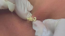 Ewww! Seemingly infinite giant pimple squeezed out by Vietnamese dermatologist
