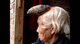 Chinese villager grows huge horn on head