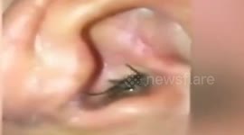 Centipede climbs into woman's ear while she's asleep +NOTE+