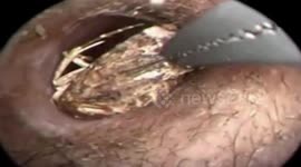 LOOP Centipede climbs into woman's ear while she's asleep