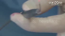 Smile Makeovers with Dental Laser