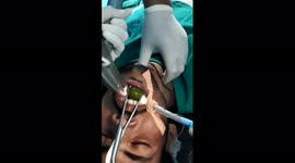 Lemon Stuck In Throat While Worshiping In Religious Program, Pulled Out With The Help Of Binoculars In 1 Hour Operation