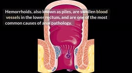 Hemorrhoids? What Foods To Eat And What Foods To Avoid |Best & Worst Foods For Hemorrhoids