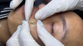 Dermatologist removes 5 years old of giant acne hidden under man's face