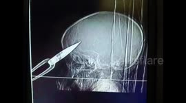 Toddler puts scissor into temple near eyes