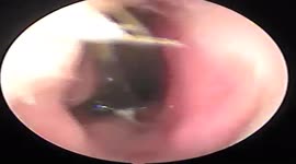 Vietnamese doctor removed the rubber band from the 4-year-old boy's nasal tube