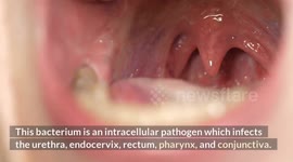 Gonorrhea - Causes, Signs & Symptoms, Diagnosis, Treatment and Prevention