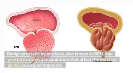 Enlarged Prostate(BPH, Prostate Cancer): Causes, Risk Factors, Signs & Symptoms, Diagnosis Treatment