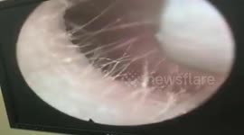 Vietnamese doctor removed the giant stone stuck in the woman's ear