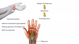 Carpal Tunnel Syndrome :- Causes, Clinical Presentation, Pathophysiology, Diagnosis & Treatment