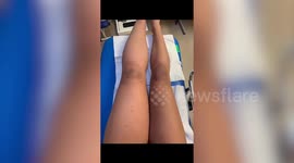 Meet the woman whose left leg is more than double the size of her right one due to a rare condition