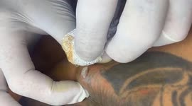 The dermatologist removed the 10-year-old giant acne on the man's back.