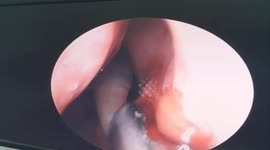 Vietnamese doctor removed the 10cm long live leech that lived in the man's nose
