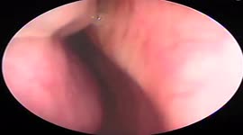 The doctor removed the 16cm long live leech that was stuck in the man's nasal canal