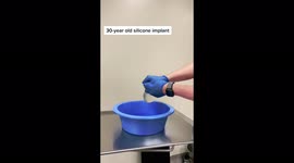 'Did her body FRY them?': TikTok doctor leaves users shocked ripping open 30-year-old silicone breast implants Part 1