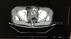 Man ends up with wire in his urethra and refuses to tell doctors how
