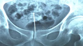 Man ends up with needle stuck in Urethra after failed medical procedure in China