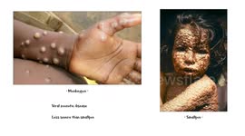 Monkeypox |The Latest Outbreak :- Everything You Need To Know - History, Prognosis, Treatment