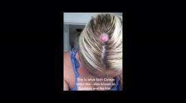 ‘My tanning obsession nearly KILLED me and left me with HOLE in my head,’ reveals London mum, 37 Part 4