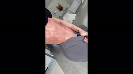 'I'm in pain every day, it feels like I have sunburn 24/7 – I can't sleep or wear tight clothes,' reveals woman, 22, with 80% of body covered in 'burning psoriasis' Part 1