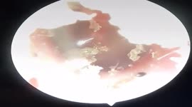 Squeamish: Poisonous ant inside man's eardrum in Vietnam
