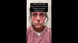 ‘I couldn’t look myself in the mirror after all of my skin peeled off – people thought I was constantly sunburnt,’ reveals woman, 26, suffering painful reaction to eczema creams. Part 2