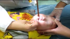 Toddler receives surgery to remove chopstick prodding into his palate